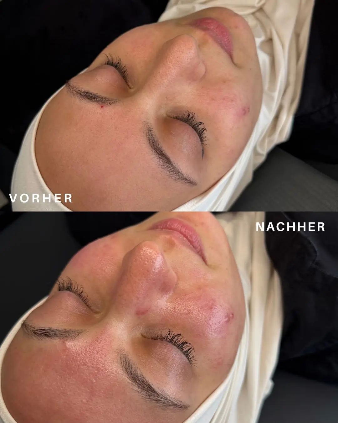 Vorher-Nachher-Vergleich einer Gesichtsbehandlung: oben Rötungen und einzelne Unreinheiten an Wange und Nase, unten ein gleichmäßigeres, frisch wirkendes Hautbild