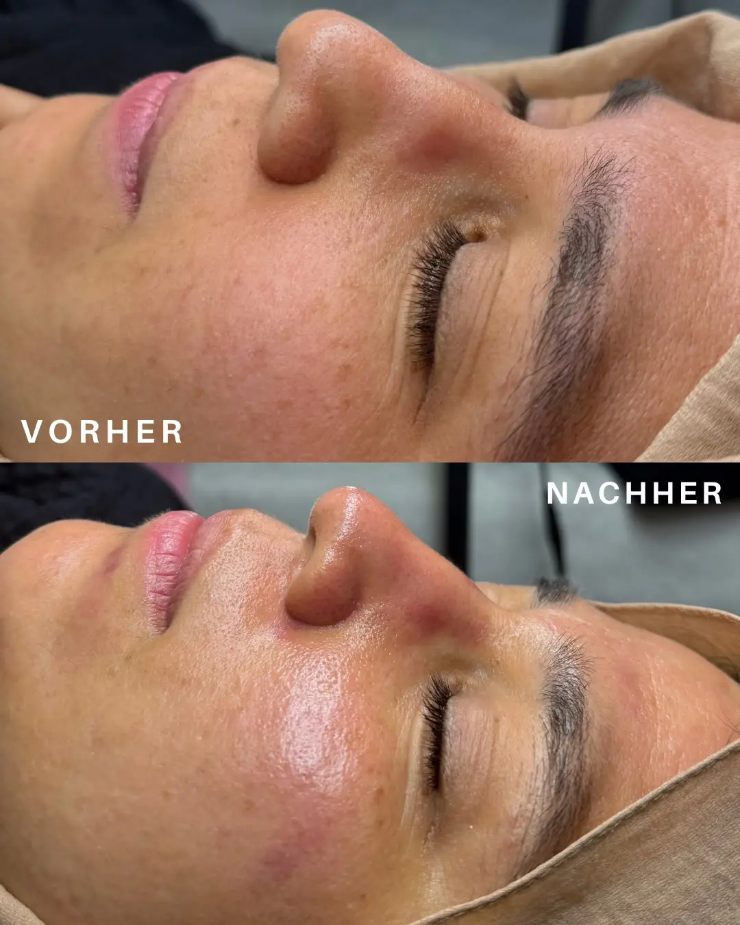 Vorher-Nachher-Vergleich im Profil: oben ein mattes, ungleichmäßiges Hautbild, unten glatter und frischer wirkende Haut