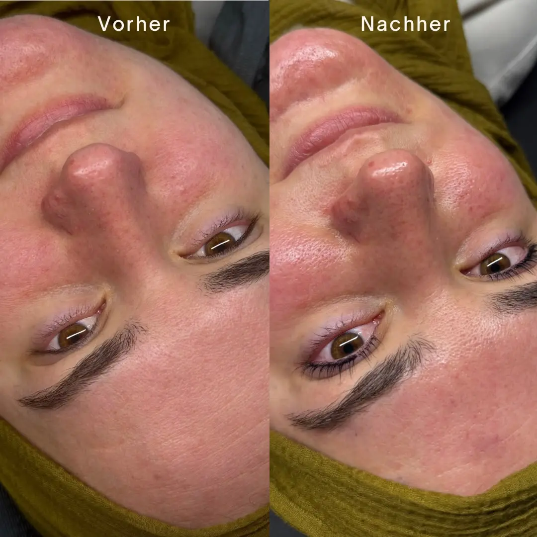 Vorher-Nachher-Vergleich nebeneinander: links die Haut vor der Behandlung, rechts danach – feiner wirkende Poren und ebenmäßigerer Teint